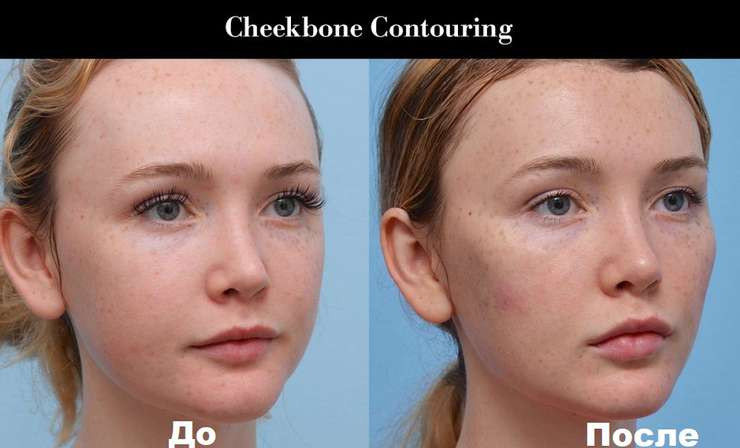 Бейби-лифтинг: секретная пластика, которую делают знаменитости - «Секреты красоты»