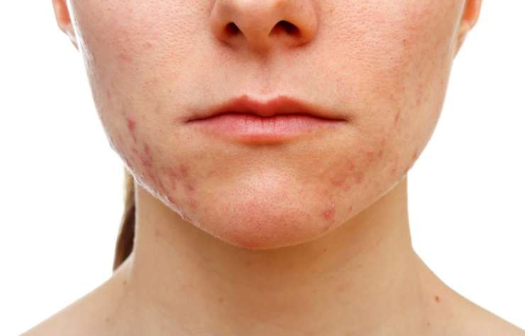 Акне: чем отличается гормональное от бактериального, какое у вас и что делать - «Секреты красоты»